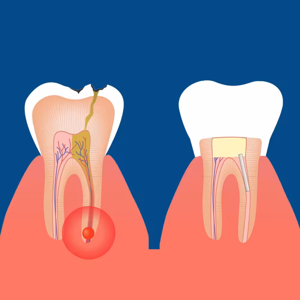 RootCanal
